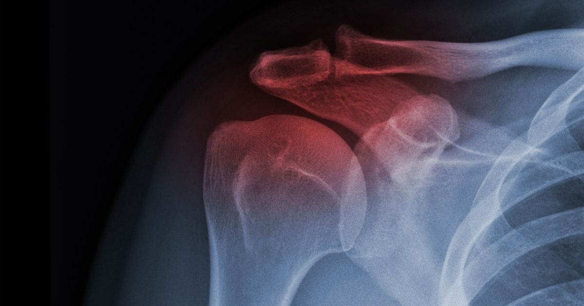 Find Legal Support for Shoulder Injuries with the Dover Car Accident Lawyers at McCann Dillon Jaffe & Lamb, LLC